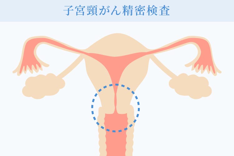 子宮頸がんについて