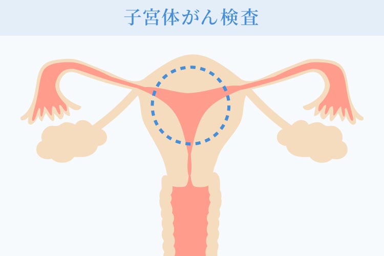 子宮体がんとは