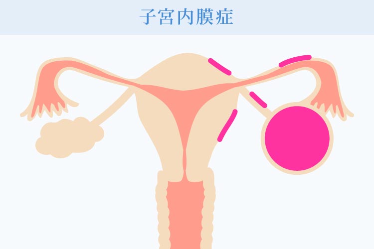 子宮内膜症とは