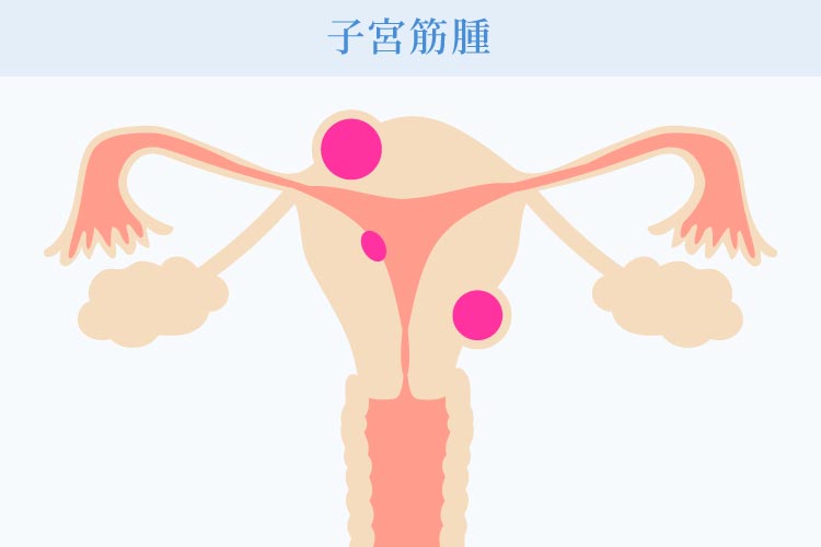 子宮筋腫とは