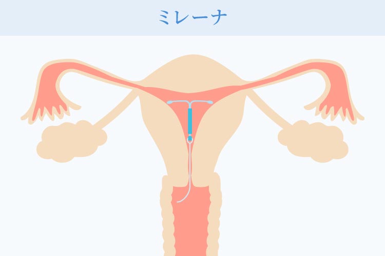 ミレーナについて