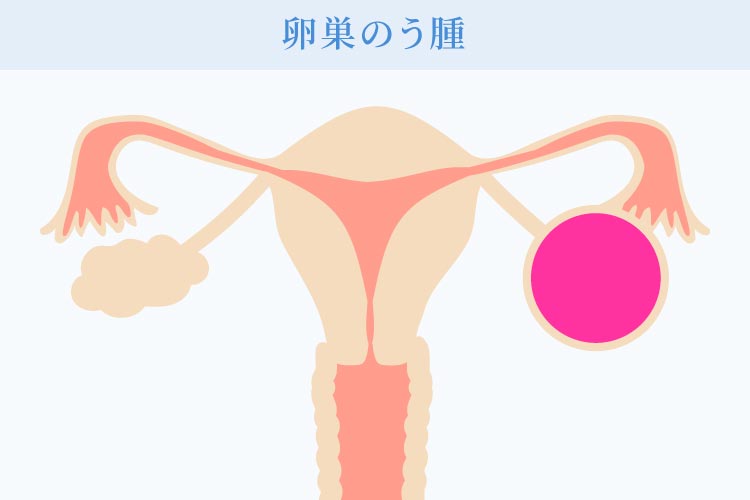 子宮筋腫とは