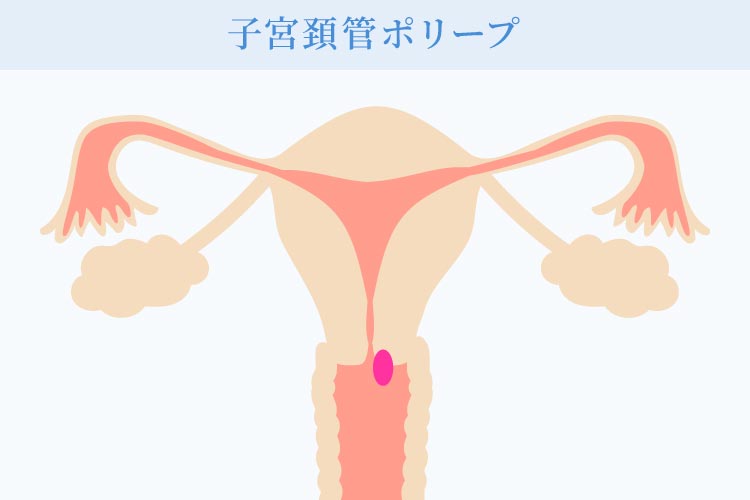子宮頸管ポリープとは